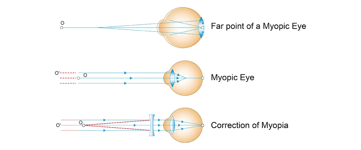 Myopia (Short-sightedness)