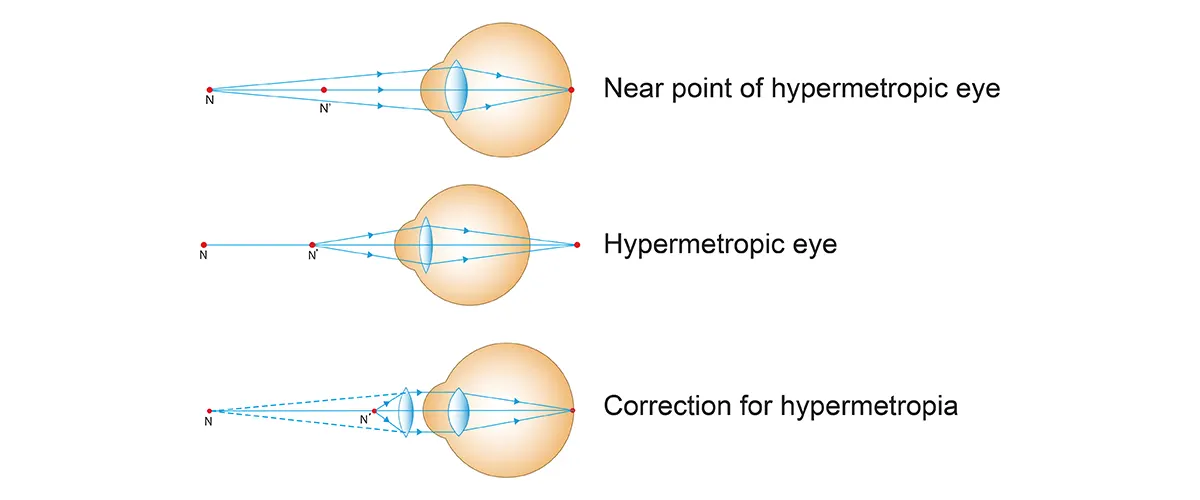 Hypermetropia (Long-sightedness)